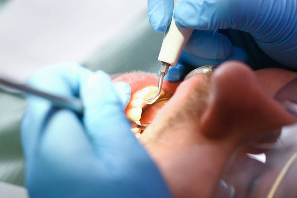 Best Emergency Dental Care for Broken or Chipped Teeth in Kayak Point, WA